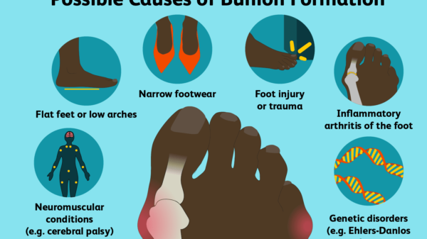 What to do about bunions
