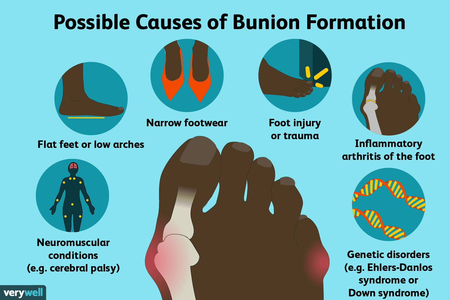 What to do about bunions